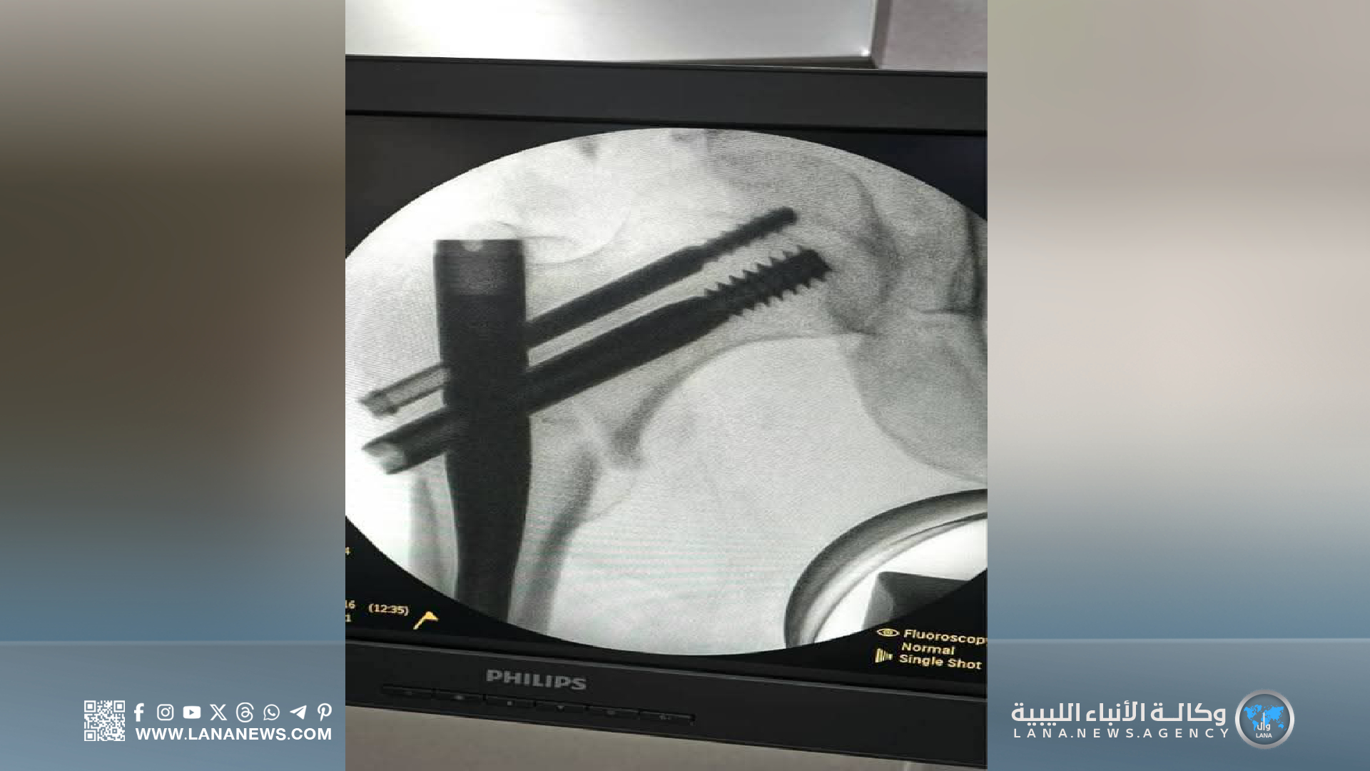 مستشفى بن سينا يُجري عملية دقيقة باستخدام أحدث تقنيات تثبيت العظام