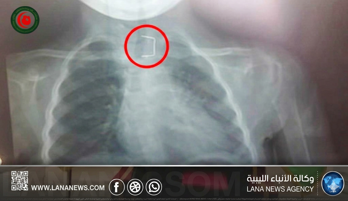 مستشفى الأطفال بنغازي ينقذ حياة طفلة ابتلعت دبوسًا