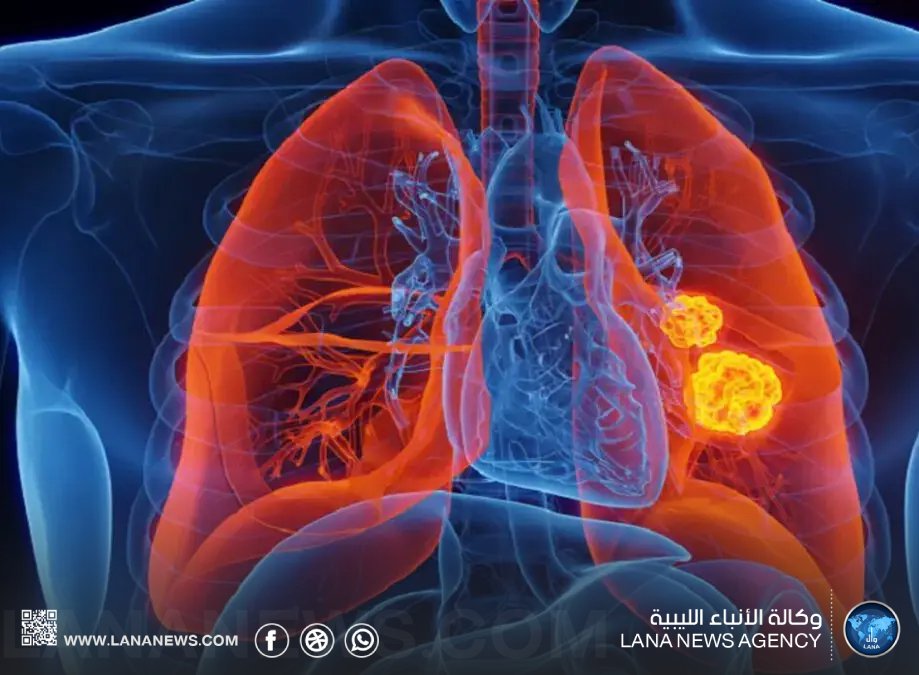 دراسة حديثة تكشف إمكانية التنبؤ بسرطان الرئة قبل سنوات من ظهوره