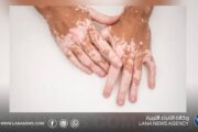 اكتشاف علمي يمهد لعلاج جديد للبهاق