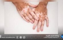 اكتشاف علمي يمهد لعلاج جديد للبهاق