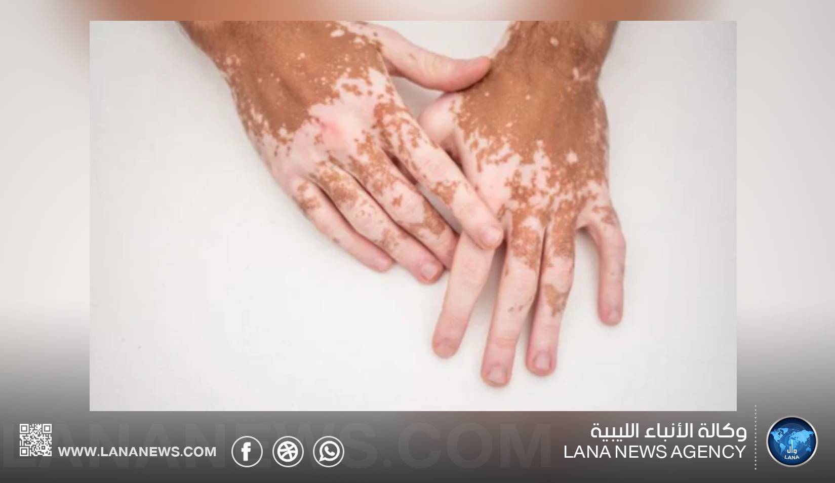 اكتشاف علمي يمهد لعلاج جديد للبهاق