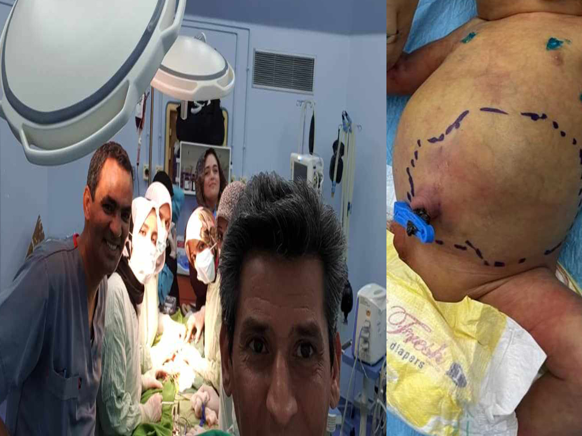 قسم الجراحة بمستشفى الأطفال بنغازي يجري عملية نادرة لمولود بداخله جنين