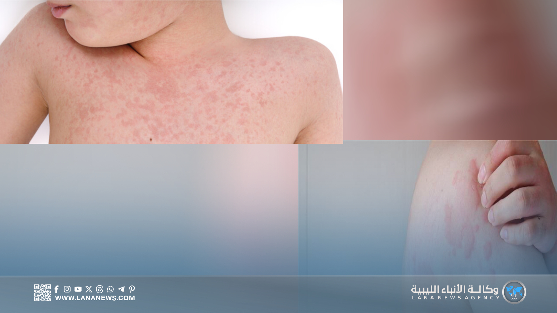 القيادة العامة تتبنى مبادرة إنسانية لعلاج الطفل زكريا القطراني بالخارج