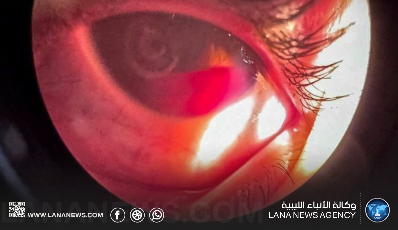تزايد حالات إصابة الأطفال بألعاب خطرة في أجدابيا