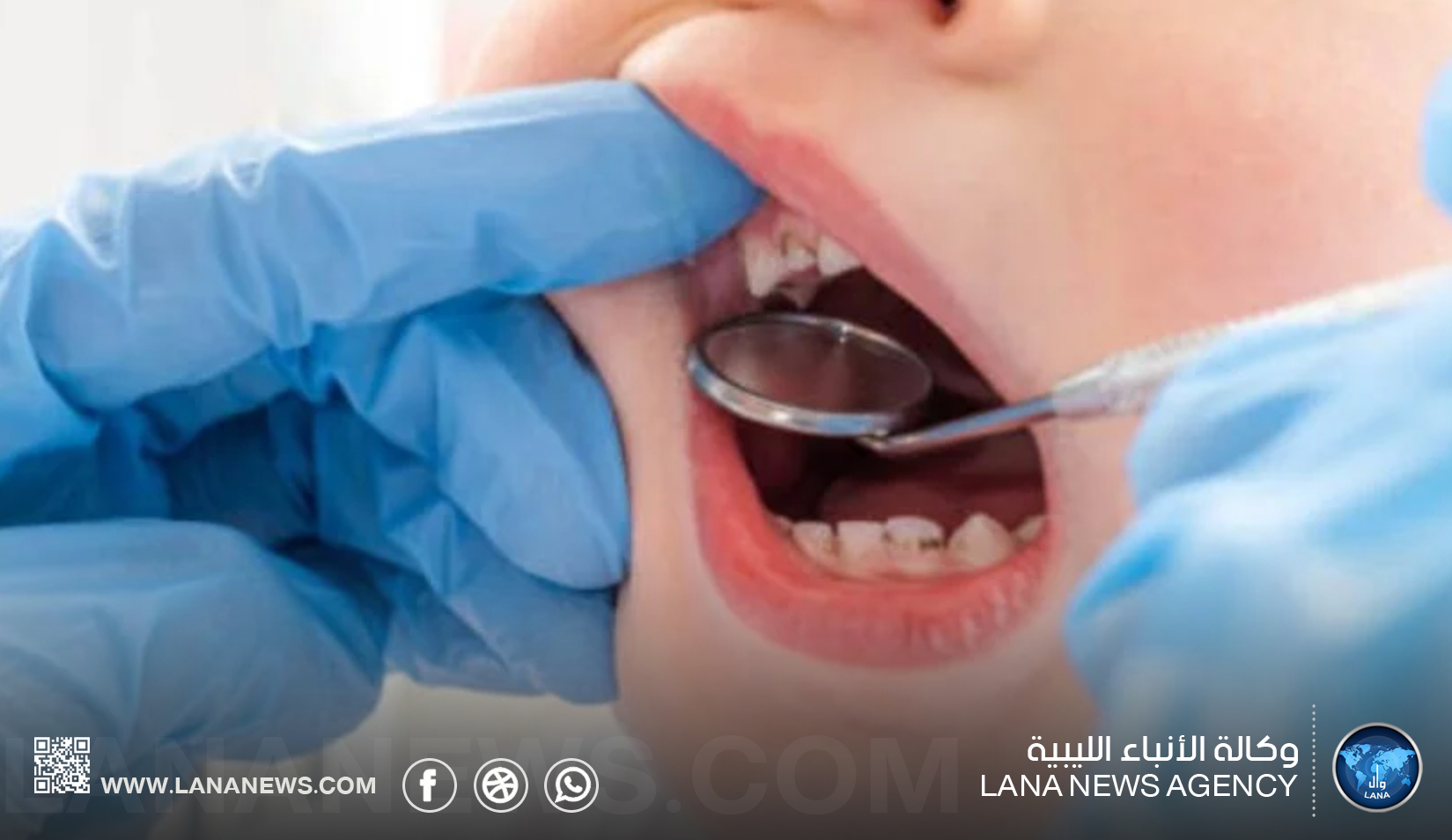 تسوس الأسنان المبكر لدى الأطفال.. أسباب متعددة ودعوات لتعزيز الوقاية